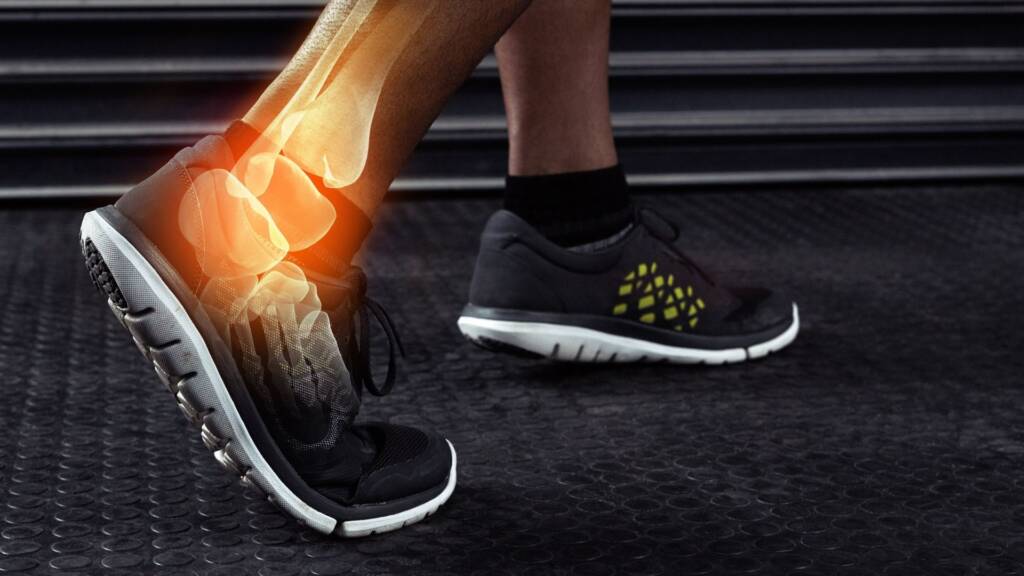 Ankle Arthritis